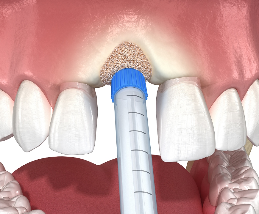 Bone Grafts