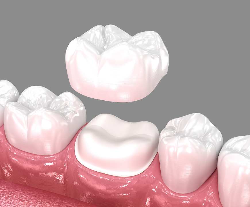 Dental Crowns