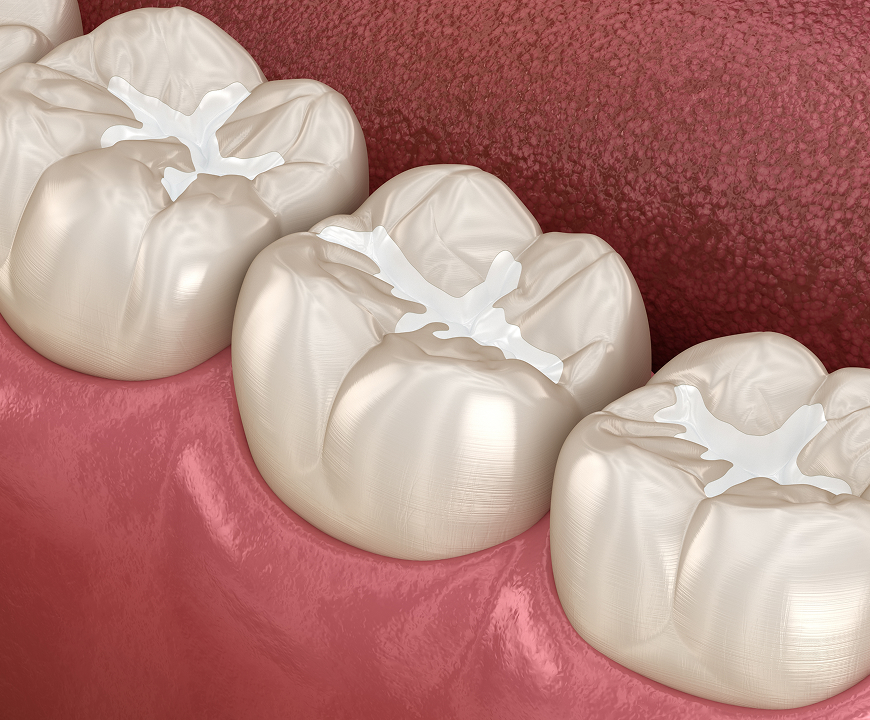Dental Fillings