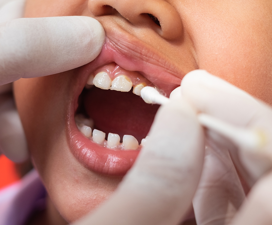 Fluoride Treatment