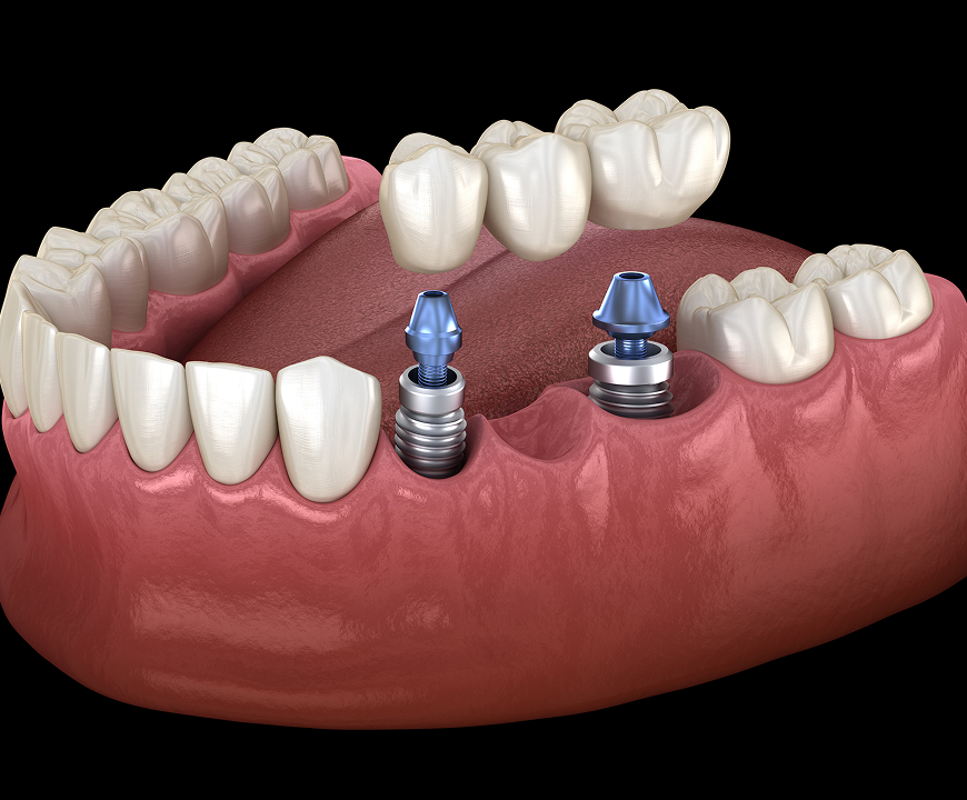 Implant Supported Bridge