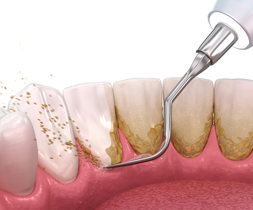 Periodontal Treatment