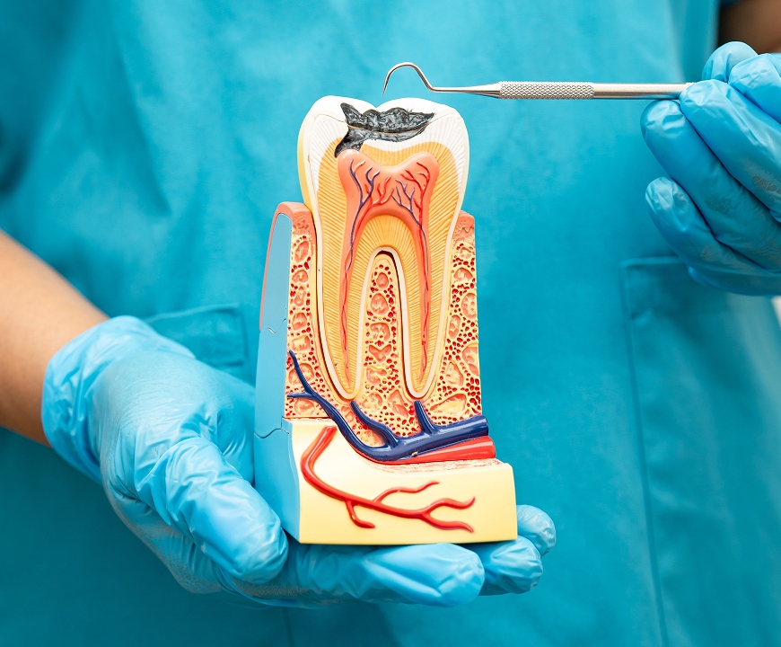 Root Canals