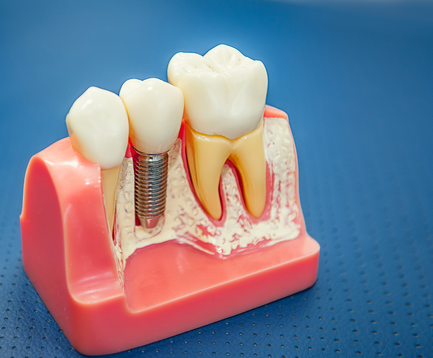 Single Tooth Implant